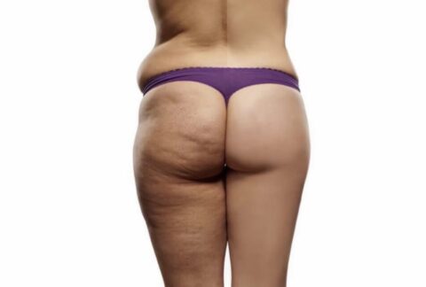 Cellulit Bodyshock wrap behandling